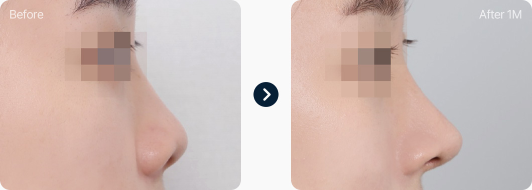 들창코 코성형 전후사진