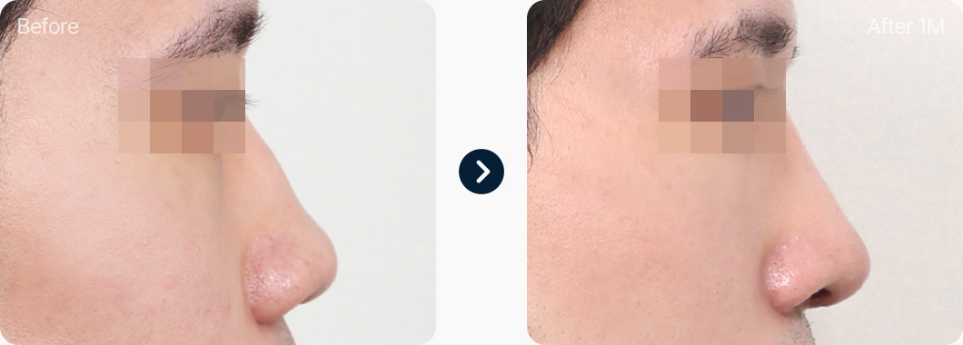 매부리코 코성형 전후사진