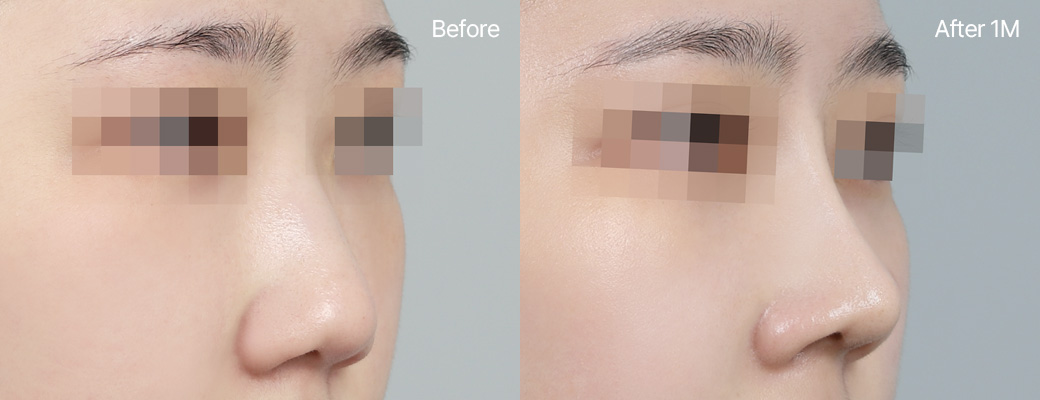 기본코성형 귀연골 전후사진