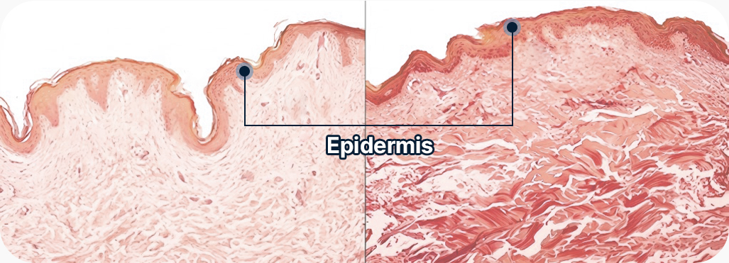 Precise Target on Collagen & Fat Cells Without Surgace Damage