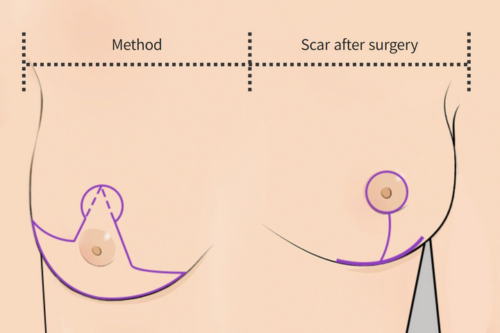 wonderful plastic surgery hospital in korea breast reduction anchor shaped incision