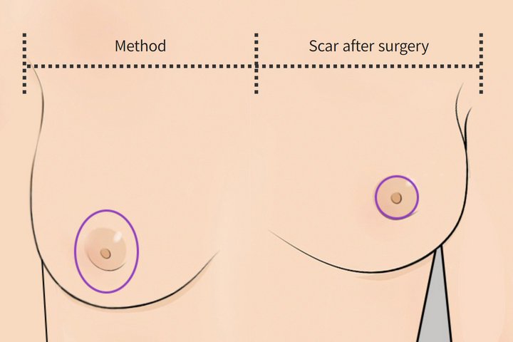 wonderful plastic surgery hospital in korea breast reduction areola incision