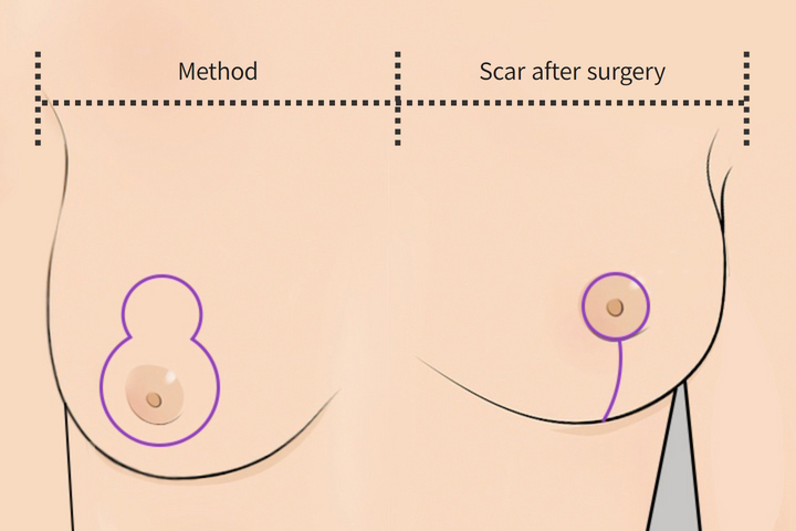 wonderful plastic surgery hospital in korea breast reduction vertical incision