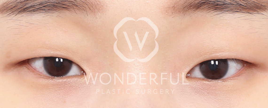 wonderful-plastic-surgery-hospital-in-korea-canthoplasty-before-after-results-before-1