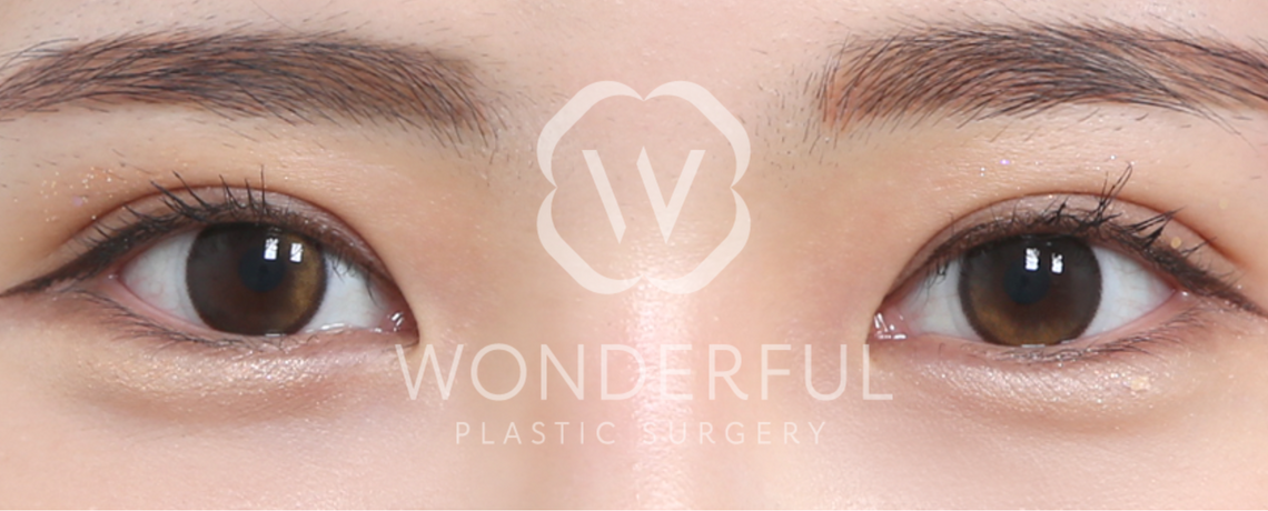 wonderful-plastic-surgery-hospital-in-korea-eye-revision-surgery-before-after-results-after-2