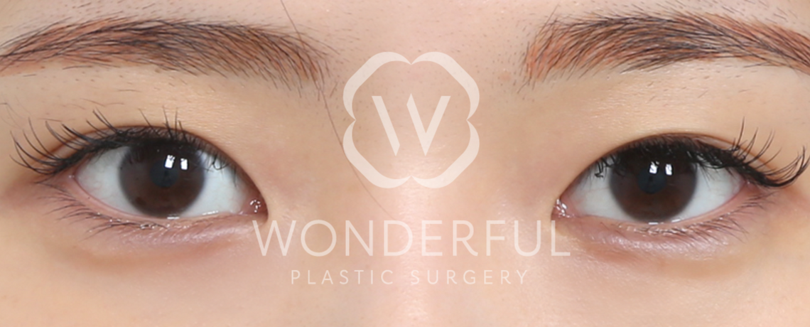 wonderful-plastic-surgery-hospital-in-korea-eye-revision-surgery-before-after-results-before-2