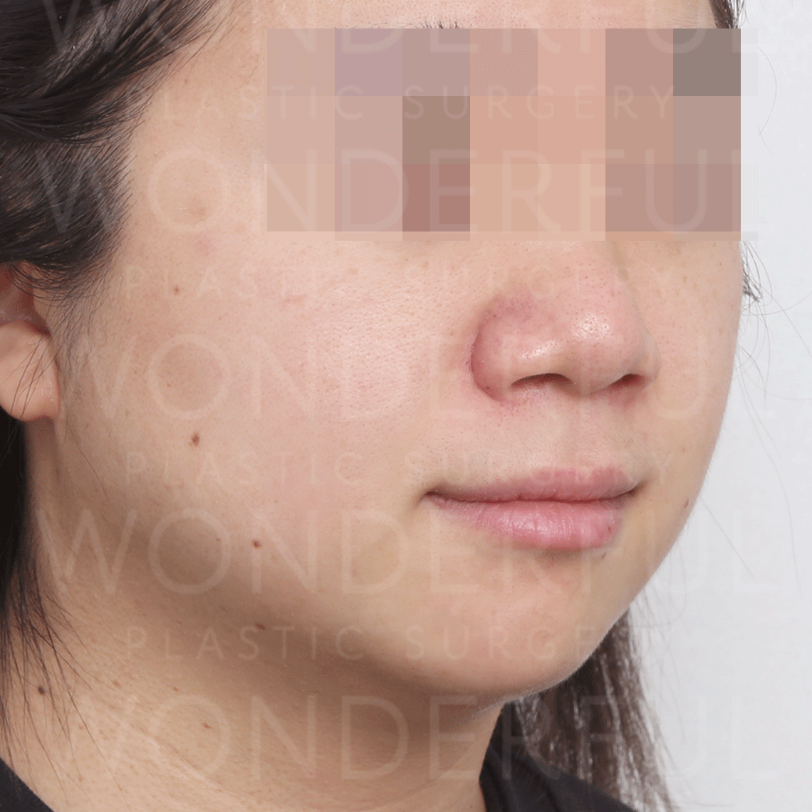 wonderful-plastic-surgery-hospital-in-korea-inmode-lifting-before-after-results-after-2