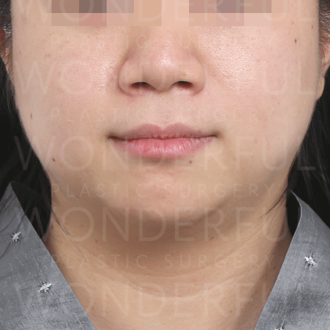wonderful-plastic-surgery-hospital-in-korea-inmode-lifting-before-after-results-before-1