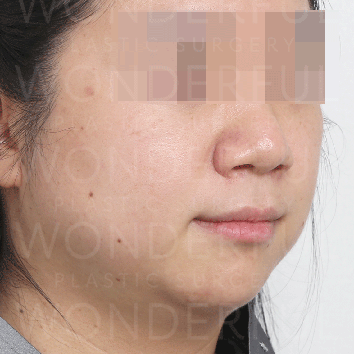 wonderful-plastic-surgery-hospital-in-korea-inmode-lifting-before-after-results-before-2