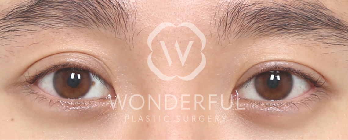 wonderful-plastic-surgery-hospital-in-korea-korean-premium-incision-double-eyelid-surgery-before-after-results-before-1