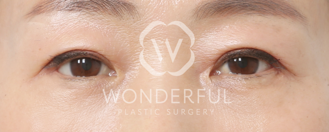 wonderful-plastic-surgery-hospital-in-korea-lower-blepharoplasty-before-after-results-after-2