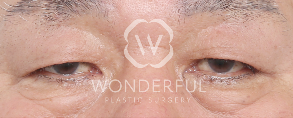wonderful-plastic-surgery-hospital-in-korea-lower-blepharoplasty-before-after-results-before-1