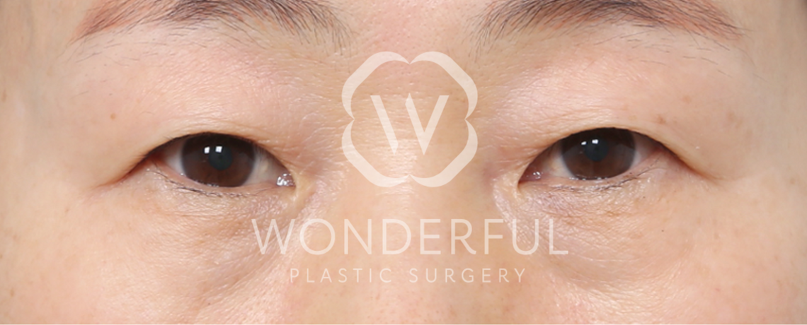 wonderful-plastic-surgery-hospital-in-korea-lower-blepharoplasty-before-after-results-before-2