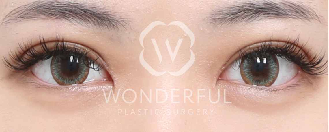 wonderful-plastic-surgery-hospital-in-korea-non-incisional-double-eyelid-surgery-before-after-results-after-1