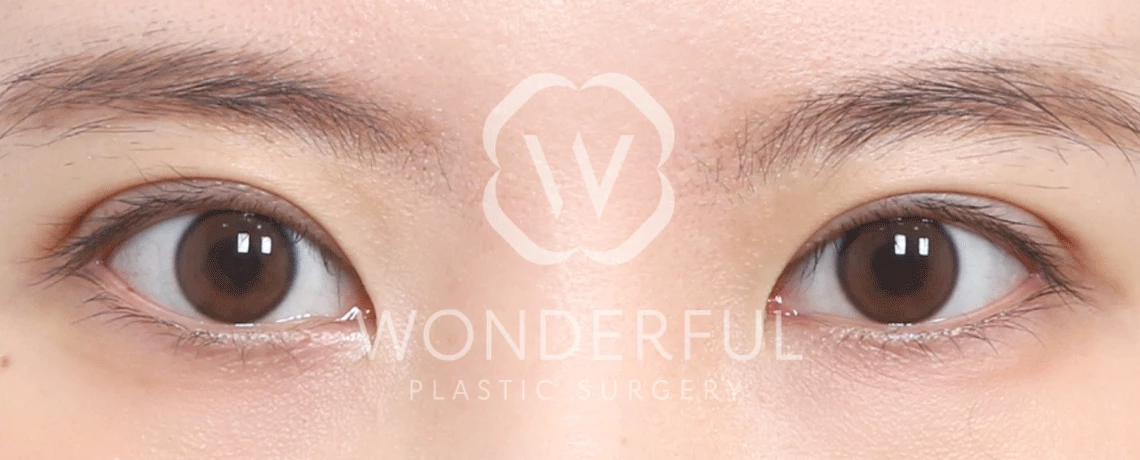 wonderful-plastic-surgery-hospital-in-korea-non-incisional-double-eyelid-surgery-before-after-results-after-2