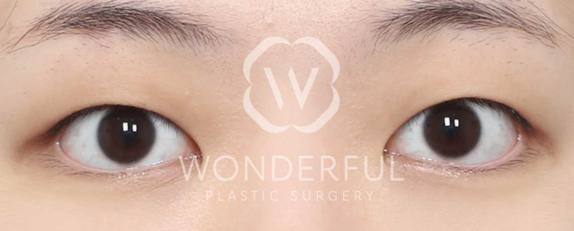 wonderful-plastic-surgery-hospital-in-korea-non-incisional-double-eyelid-surgery-before-after-results-before-1
