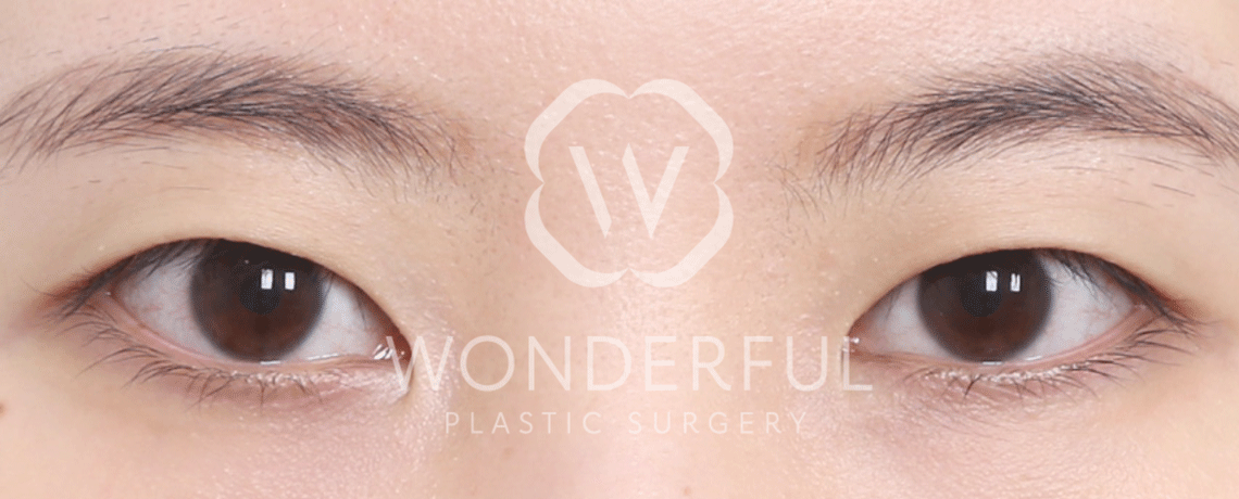 wonderful-plastic-surgery-hospital-in-korea-non-incisional-double-eyelid-surgery-before-after-results-before-2