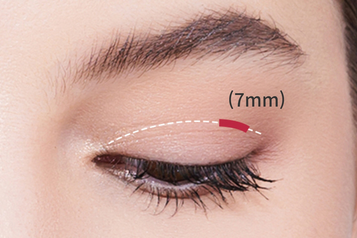 wonderful plastic surgery hospital in korea partial incision double eyelid surgery method step 2