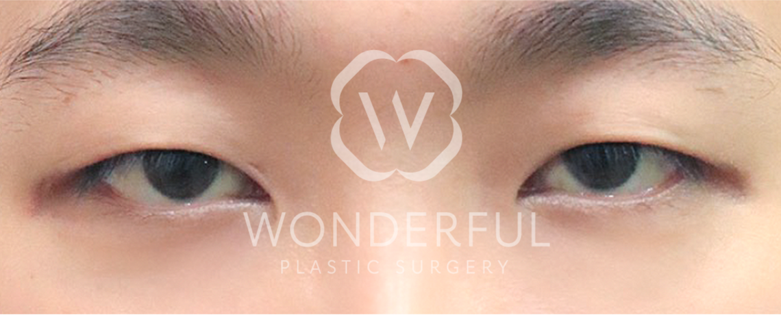 wonderful-plastic-surgery-hospital-in-korea-ptosis-correction-surgery-before-after-results-before-1