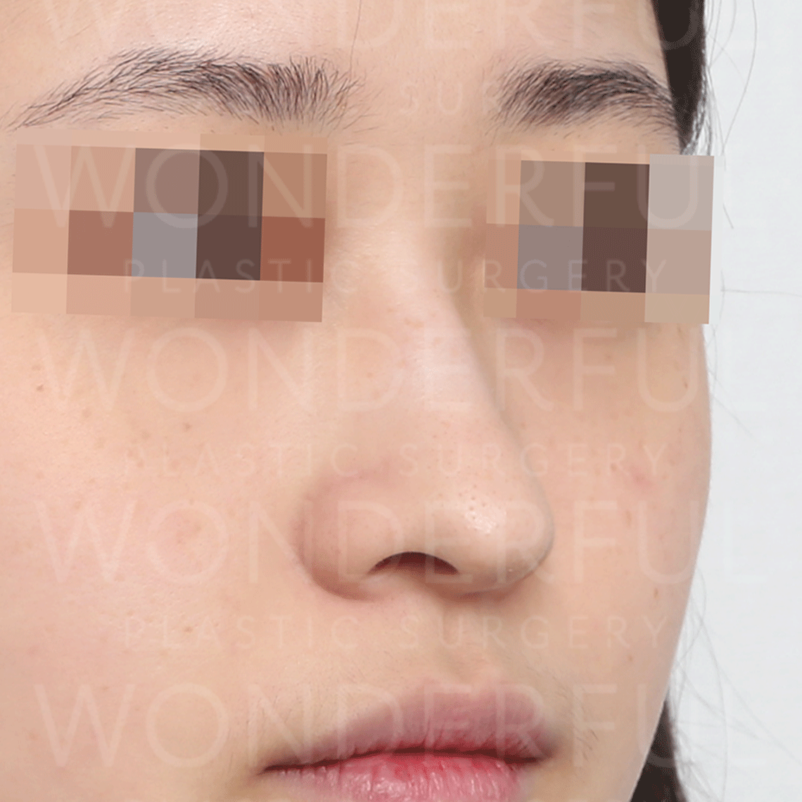 wonderful-plastic-surgery-hospital-korea-arrow-nose-rhinoplasty-before-after-results-before-1