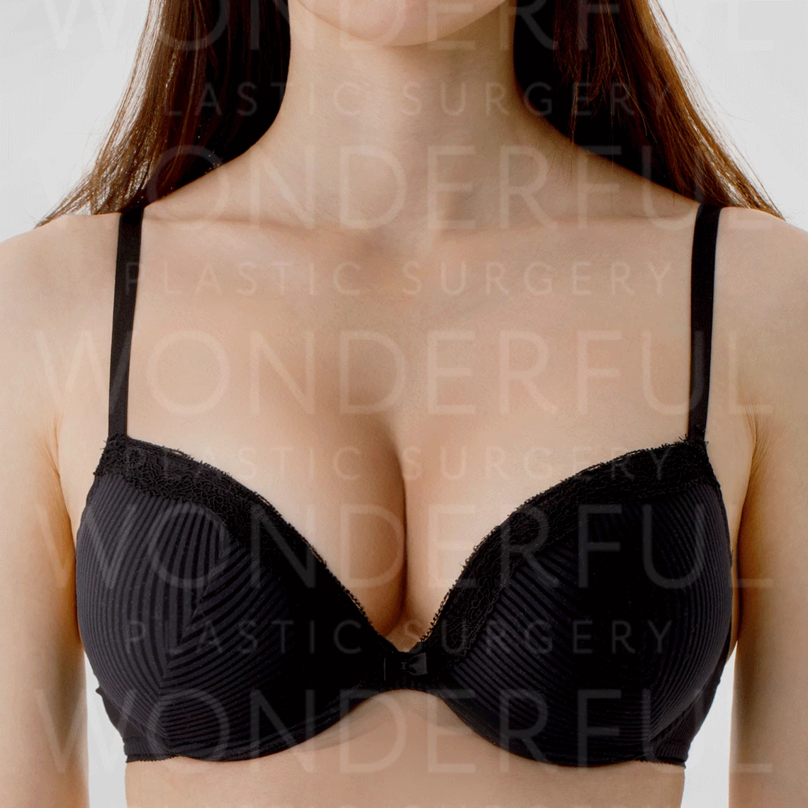 wonderful-plastic-surgery-hospital-korea-breast-augmentation-before-after-results-after-1。