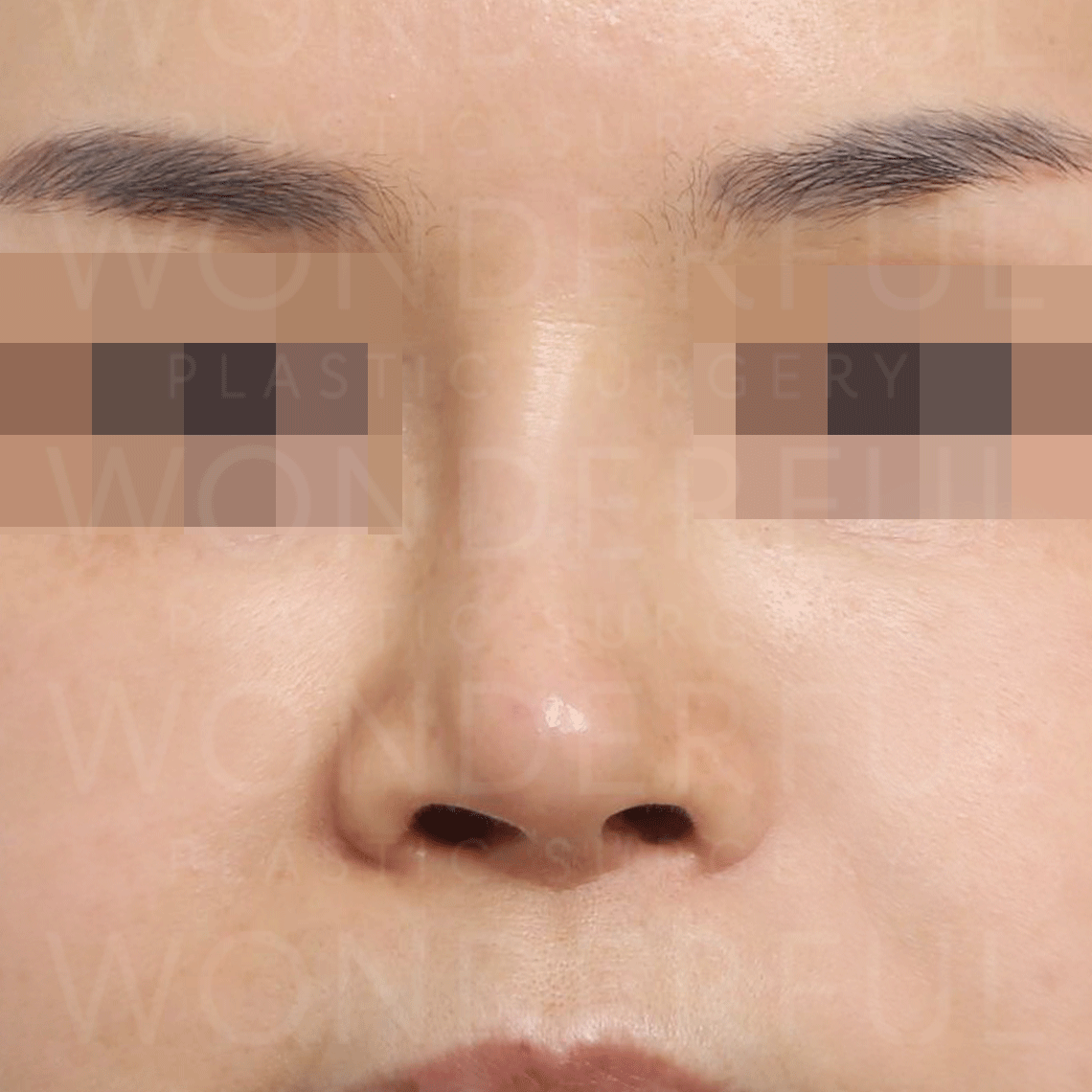 wonderful-plastic-surgery-hospital-korea-deviated-nose-rhinoplasty-before-after-results-before-1