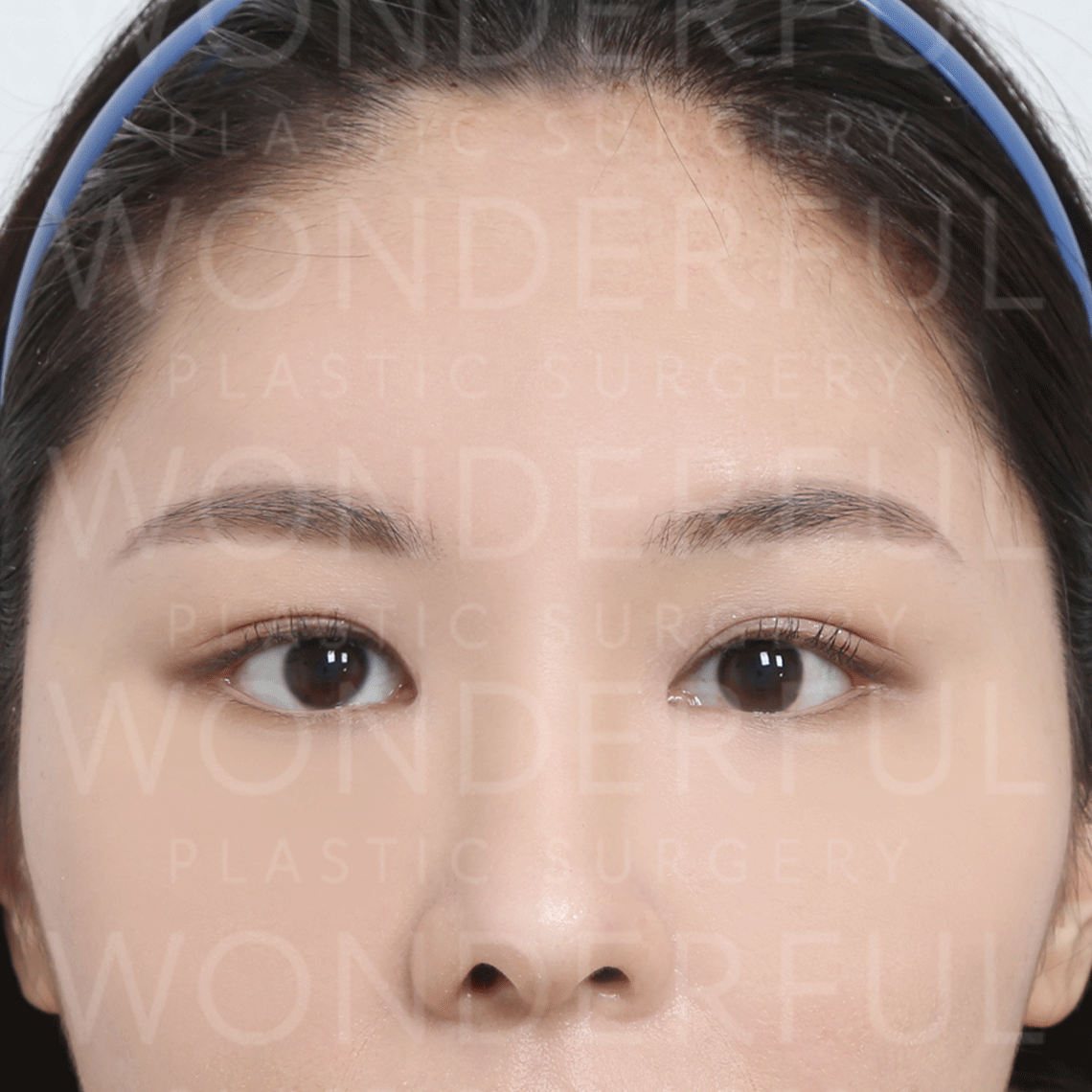 wonderful-plastic-surgery-hospital-korea-endoscopic-fore-head-lift-surgery-before-after-results-after-1