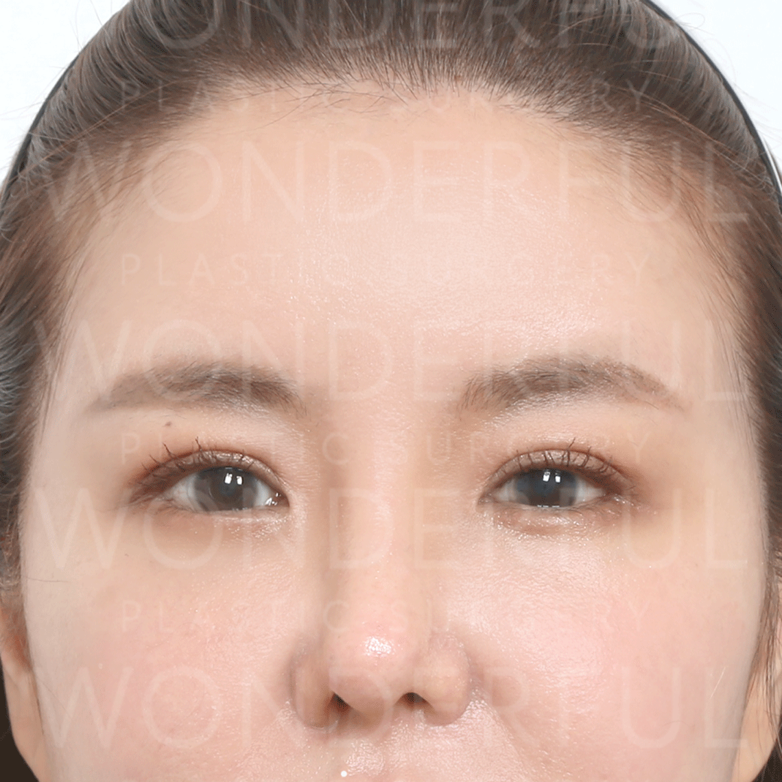 wonderful-plastic-surgery-hospital-korea-endoscopic-fore-head-lift-surgery-before-after-results-after-2