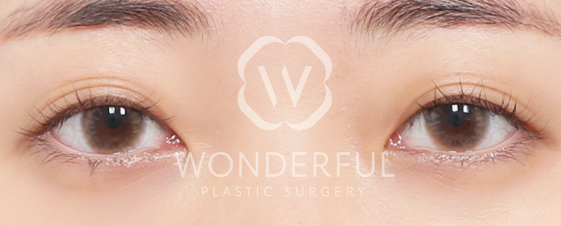 wonderful-plastic-surgery-hospital-korea-korean-partial-incision-double-eyelid-surgery-before-after-results-before-2