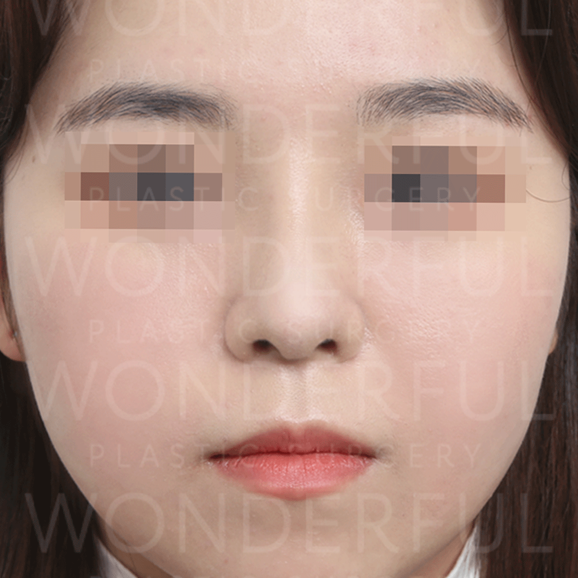 wonderful-plastic-surgery-hospital-korea-nose-rhinoplasty-before-after-results-after-1