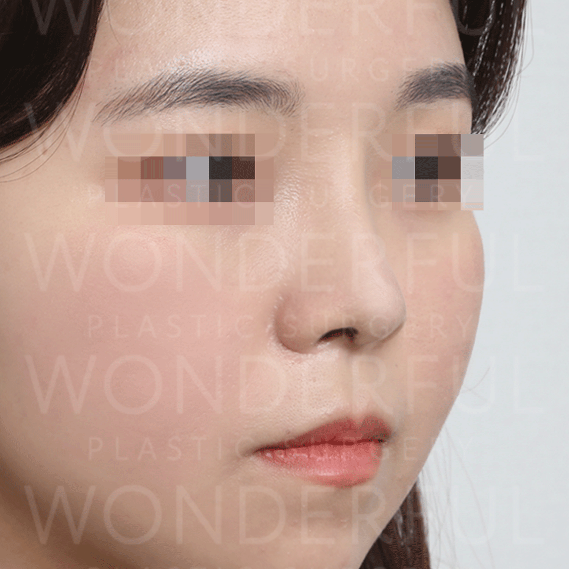 wonderful-plastic-surgery-hospital-korea-nose-rhinoplasty-before-after-results-after-2
