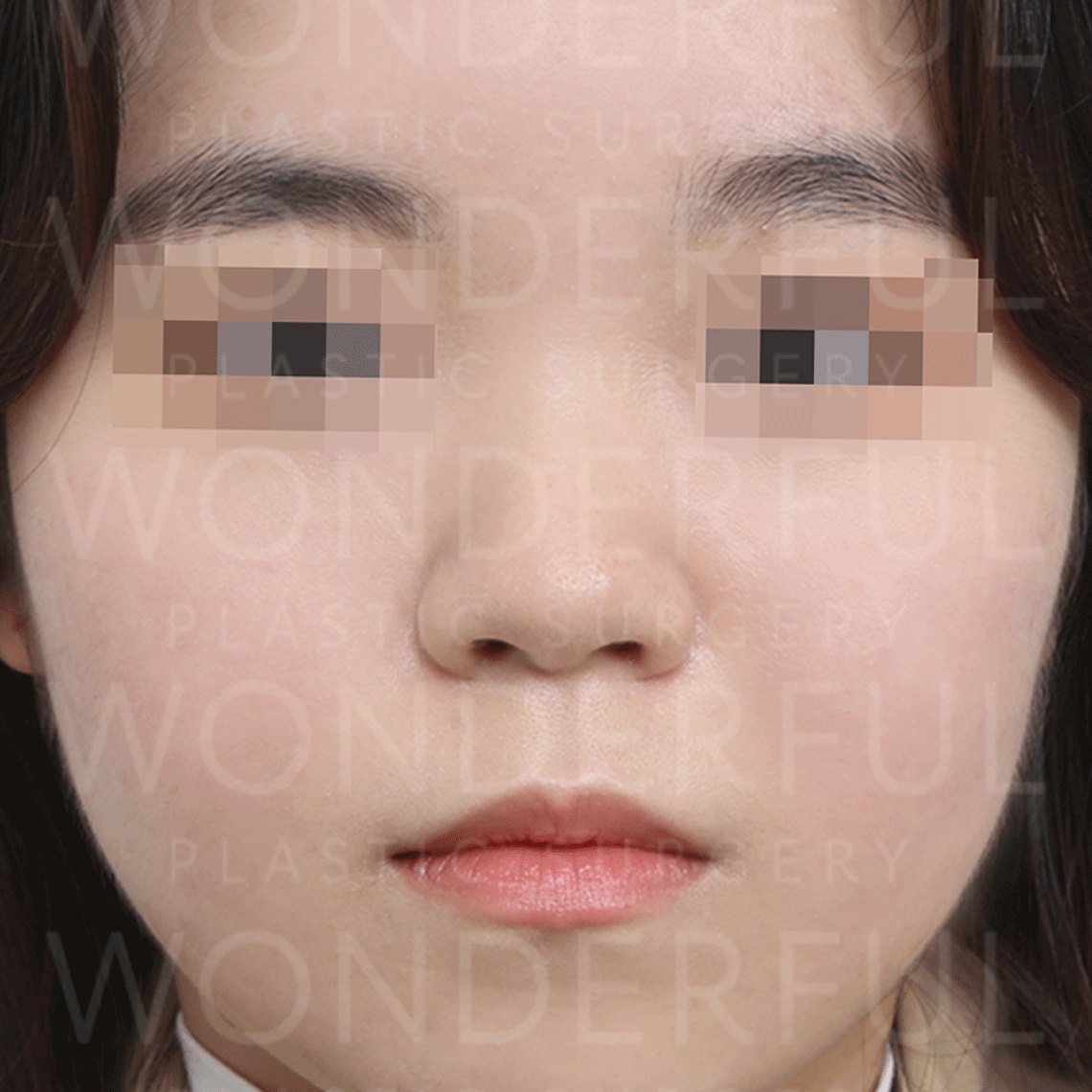 wonderful-plastic-surgery-hospital-korea-nose-rhinoplasty-before-after-results-before-1