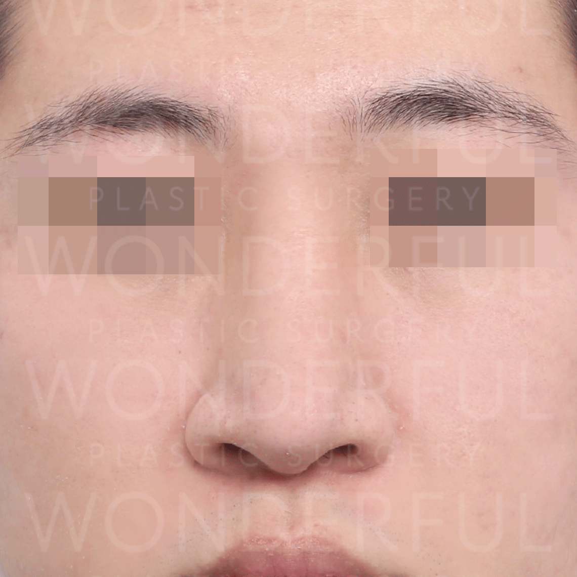 wonderful-plastic-surgery-hospital-korea-wide-nose-rhinoplasty-before-after-results-before-1